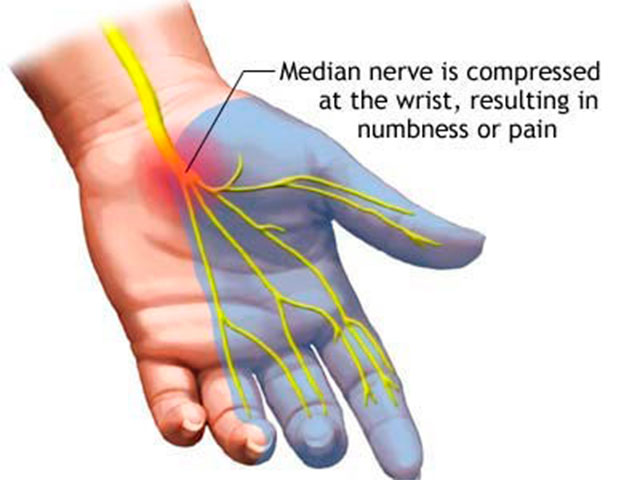 KT Tape: Carpal Tunnel 